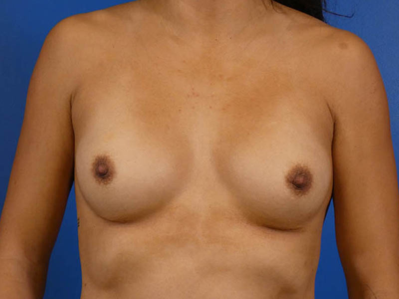 Breast Revision Before and After | Plastic Surgery Associates of Valdosta