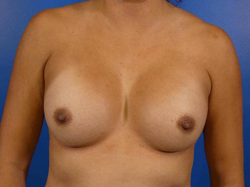 Breast Revision Before and After | Plastic Surgery Associates of Valdosta