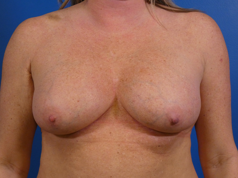 Breast Revision Before and After | Plastic Surgery Associates of Valdosta