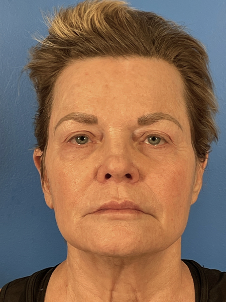 Eyelid Lift Before and After | Plastic Surgery Associates of Valdosta