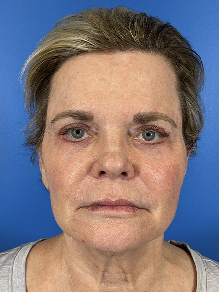 Eyelid Lift Before and After | Plastic Surgery Associates of Valdosta