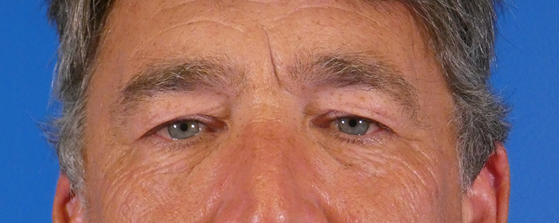 Eyelid Lift Before and After | Plastic Surgery Associates of Valdosta