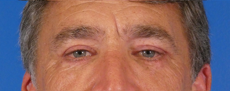 Eyelid Lift Before and After | Plastic Surgery Associates of Valdosta