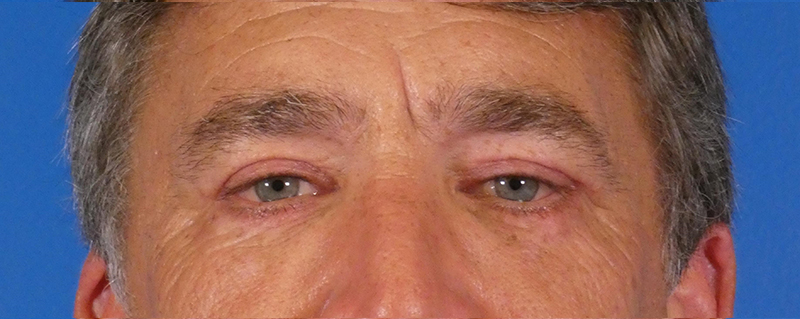 Eyelid Lift Before and After | Plastic Surgery Associates of Valdosta