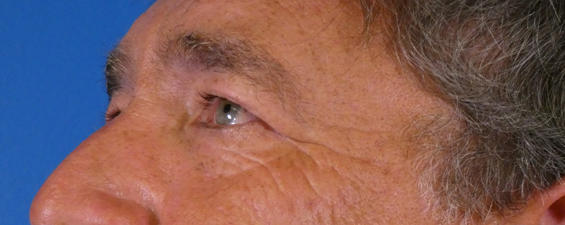 Eyelid Lift Before and After | Plastic Surgery Associates of Valdosta