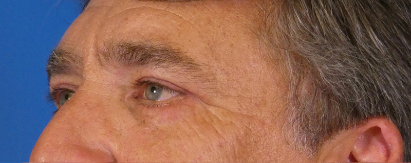 Eyelid Lift Before and After | Plastic Surgery Associates of Valdosta