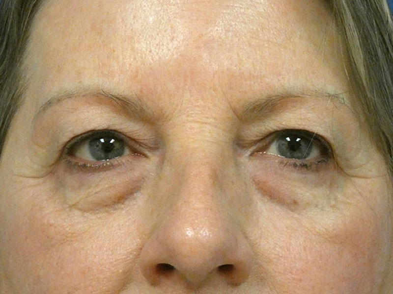 Eyelid Lift Before and After | Plastic Surgery Associates of Valdosta