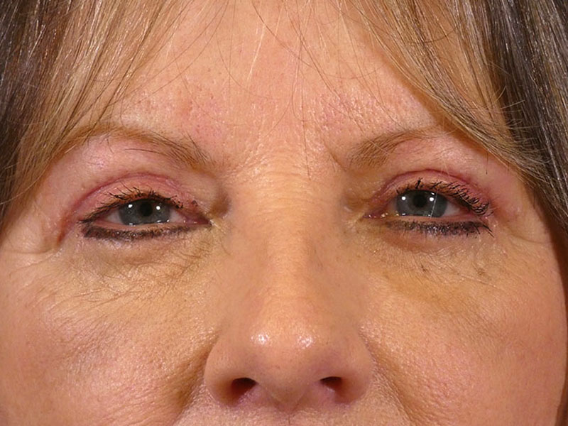 Eyelid Lift Before and After | Plastic Surgery Associates of Valdosta