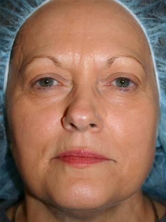 Eyelid Lift Before and After | Plastic Surgery Associates of Valdosta