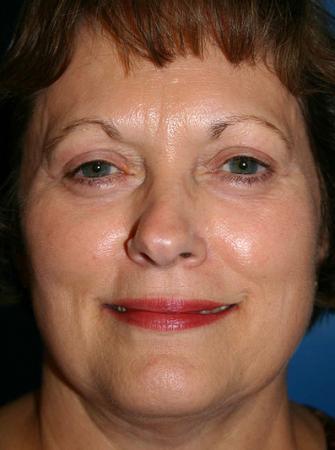 Eyelid Lift Before and After | Plastic Surgery Associates of Valdosta