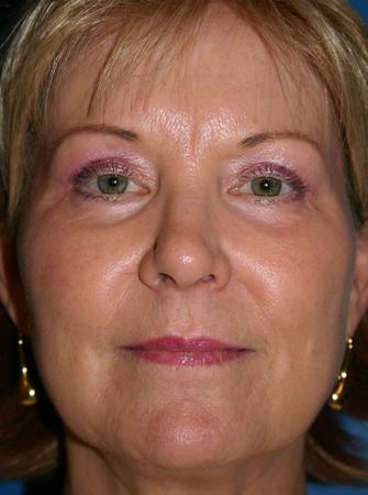 Eyelid Lift Before and After | Plastic Surgery Associates of Valdosta