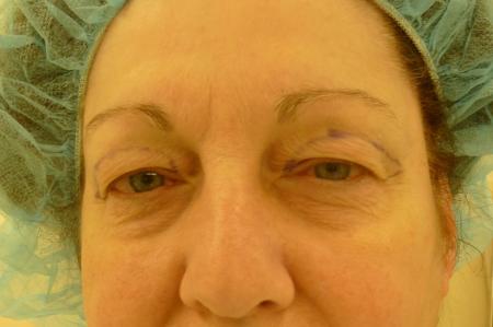 Eyelid Lift Before and After | Plastic Surgery Associates of Valdosta