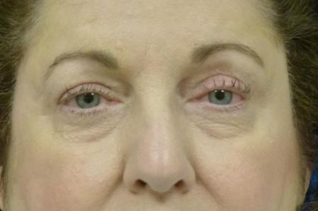 Eyelid Lift Before and After | Plastic Surgery Associates of Valdosta