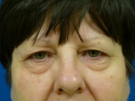 Eyelid Lift Before and After | Plastic Surgery Associates of Valdosta