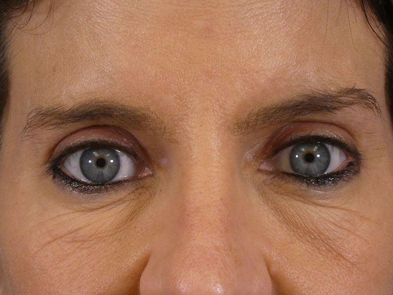 Eyelid Lift Before and After | Plastic Surgery Associates of Valdosta