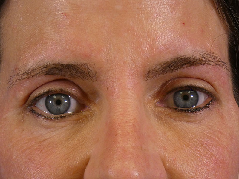 Eyelid Lift Before and After | Plastic Surgery Associates of Valdosta