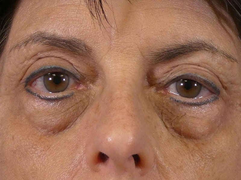 Eyelid Lift Before and After | Plastic Surgery Associates of Valdosta