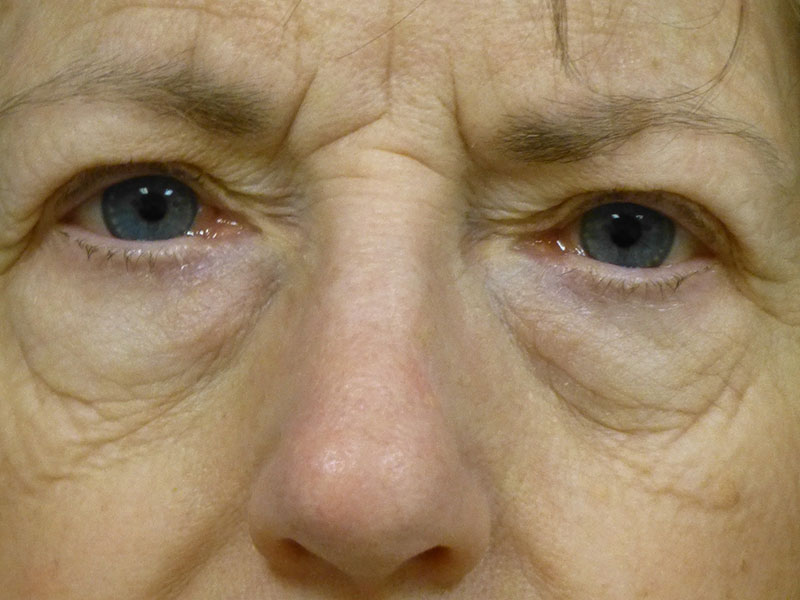 Eyelid Lift Before and After | Plastic Surgery Associates of Valdosta