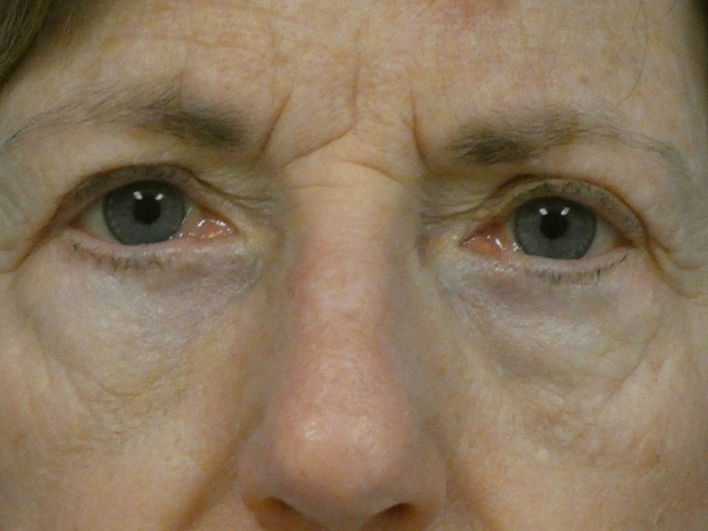 Eyelid Lift Before and After | Plastic Surgery Associates of Valdosta