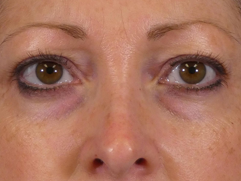 Eyelid Lift Before and After | Plastic Surgery Associates of Valdosta