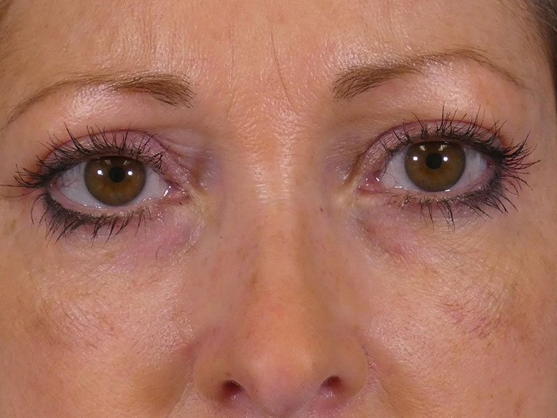 Eyelid Lift Before and After | Plastic Surgery Associates of Valdosta