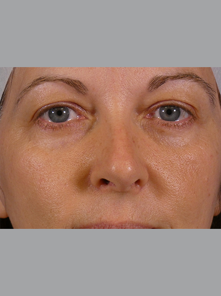 Eyelid Lift Before and After | Plastic Surgery Associates of Valdosta