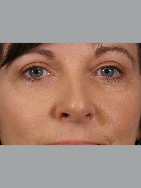 Eyelid Lift Before and After | Plastic Surgery Associates of Valdosta