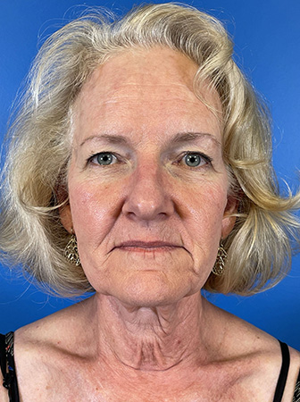 Facelift Before and After | Plastic Surgery Associates of Valdosta