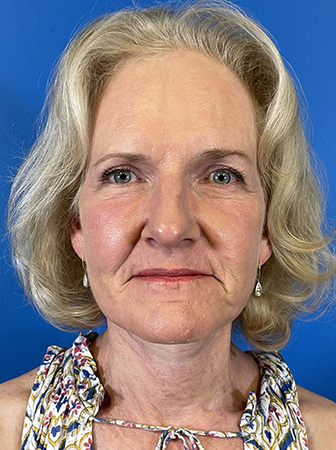 Facelift Before and After | Plastic Surgery Associates of Valdosta