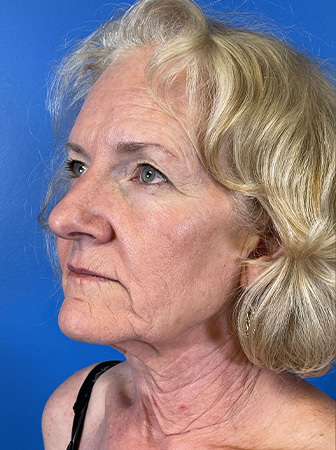 Facelift Before and After | Plastic Surgery Associates of Valdosta