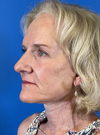 Facelift Before and After | Plastic Surgery Associates of Valdosta