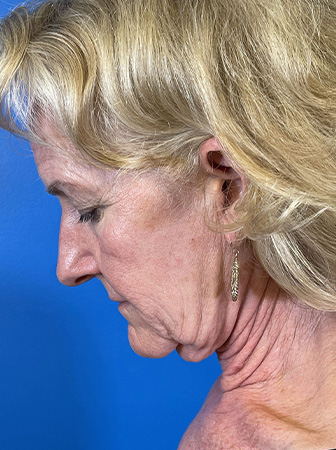 Facelift Before and After | Plastic Surgery Associates of Valdosta