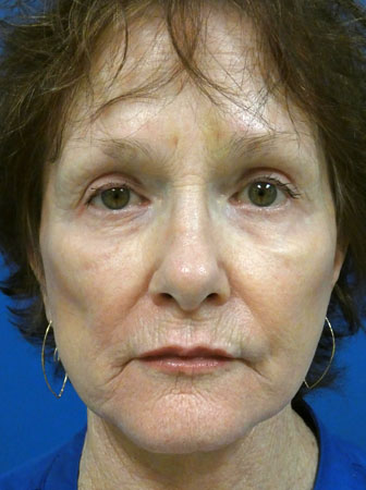 Facelift Before and After | Plastic Surgery Associates of Valdosta