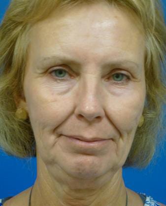 Facelift Before and After | Plastic Surgery Associates of Valdosta