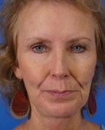 Facelift Before and After | Plastic Surgery Associates of Valdosta