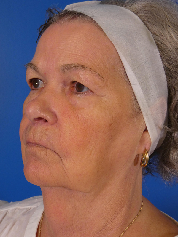 Facelift Before and After | Plastic Surgery Associates of Valdosta