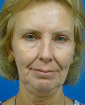 Facelift Before and After | Plastic Surgery Associates of Valdosta