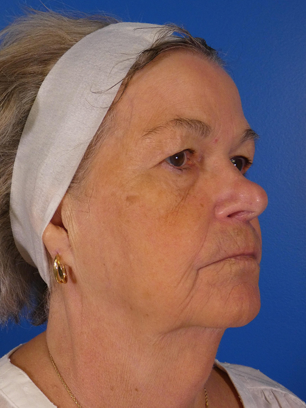 Facelift Before and After | Plastic Surgery Associates of Valdosta