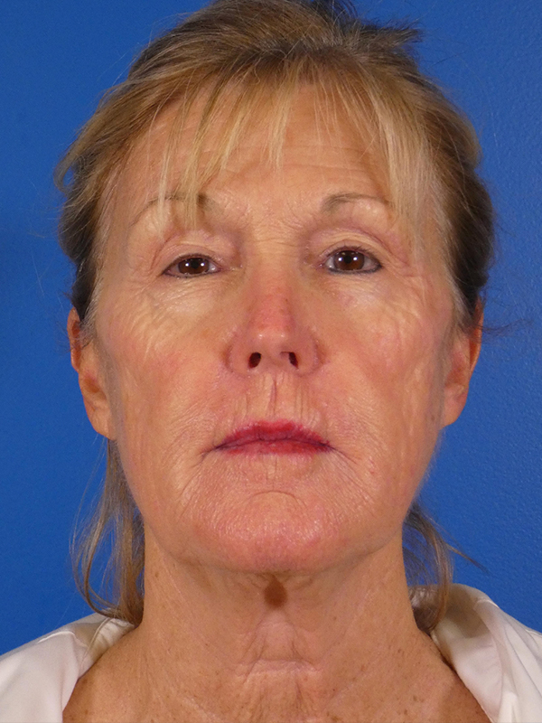 Facelift Before and After | Plastic Surgery Associates of Valdosta