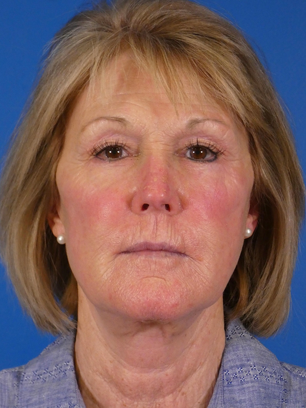 Facelift Before and After | Plastic Surgery Associates of Valdosta