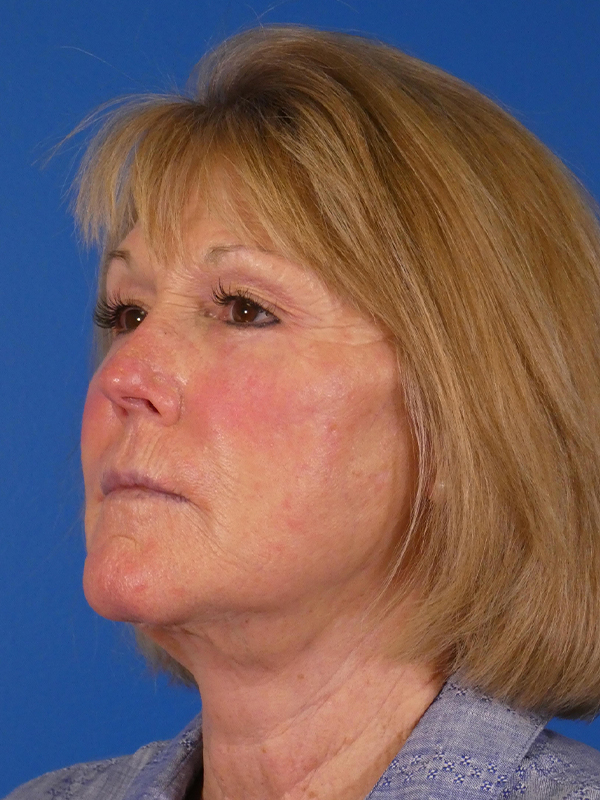 Facelift Before and After | Plastic Surgery Associates of Valdosta