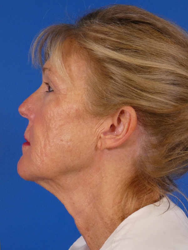 Facelift Before and After | Plastic Surgery Associates of Valdosta