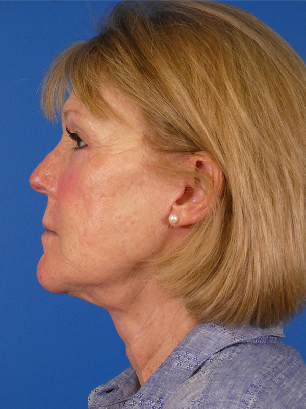 Facelift Before and After | Plastic Surgery Associates of Valdosta