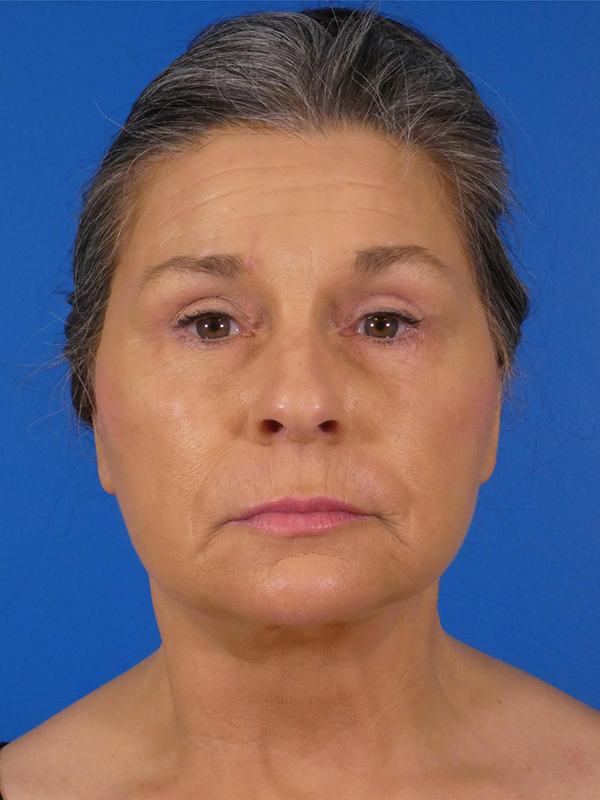 Facelift Before and After | Plastic Surgery Associates of Valdosta