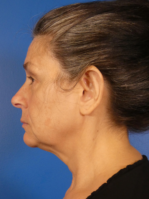 Facelift Before and After | Plastic Surgery Associates of Valdosta