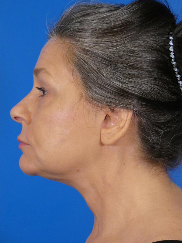 Facelift Before and After | Plastic Surgery Associates of Valdosta