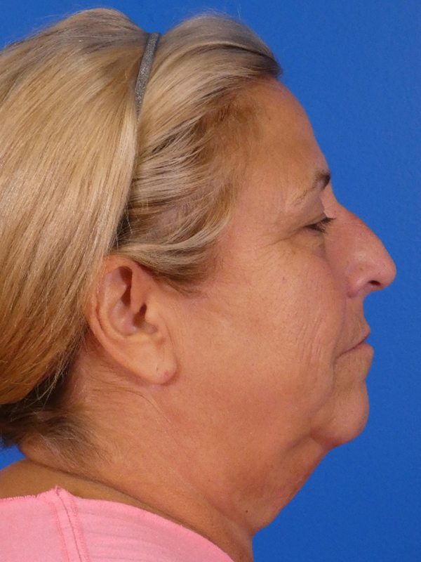 Facelift Before and After | Plastic Surgery Associates of Valdosta