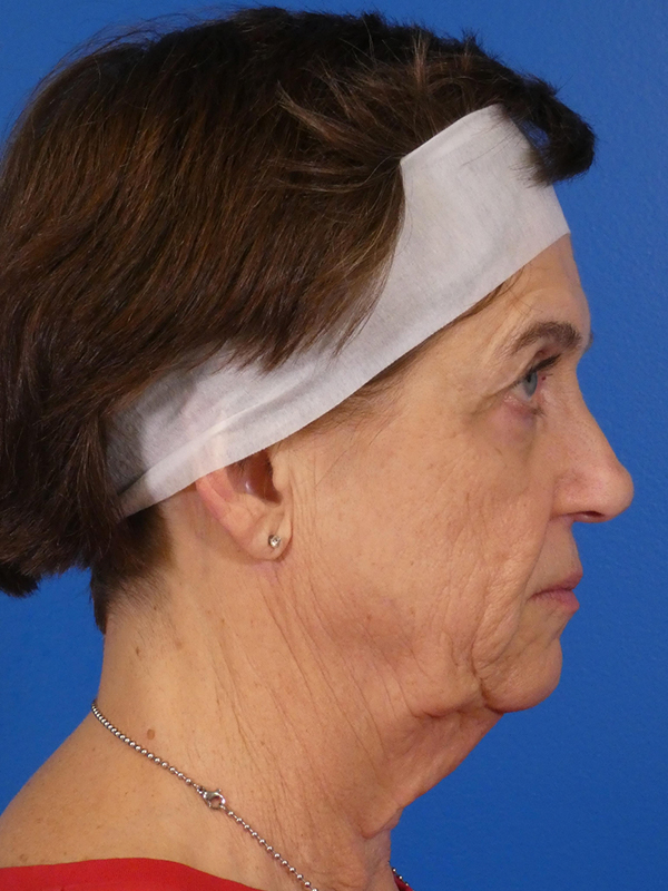 Facelift Before and After | Plastic Surgery Associates of Valdosta