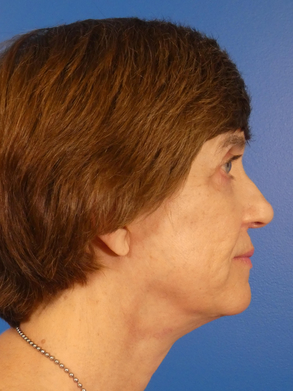 Facelift Before and After | Plastic Surgery Associates of Valdosta