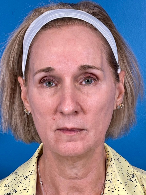 Facelift Before and After | Plastic Surgery Associates of Valdosta